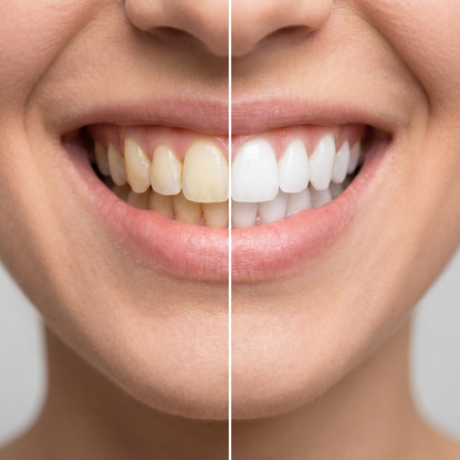 Aurven Pearl™ Whitening Strips